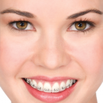 brackets-ceramicos-v275x360