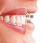 brackets-invisalign-full-v275x360