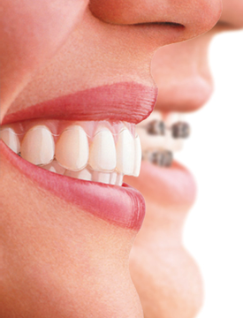 Ortodoncia Invisalign Full