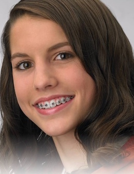 Brackets autoligados