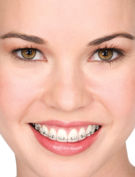 Brackets cerÃÂámicos