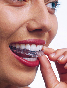 Brackets Invisalign Litel