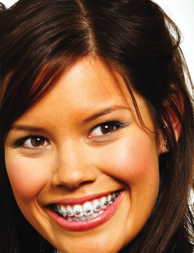 Brackets metÃÂÃÂÃÂÃÂÃÂÃÂÃÂálicos