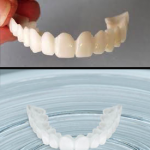 snap-on-smile-v275x360
