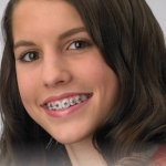 brackets baixa friccio