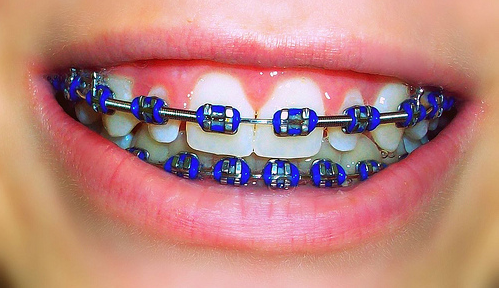 Ortodoncia - Brackets